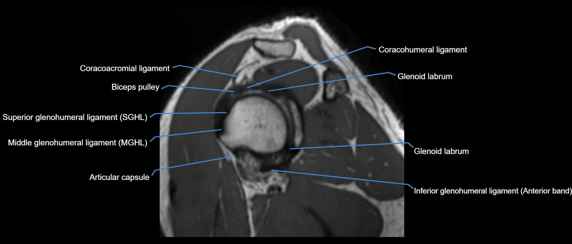 shoulder ligaments sagittal  cross sectional anatomy 3T MRI AI enhanced radiology image -img-00001-00030.webp